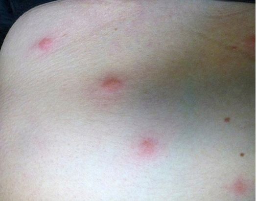 bed bug bites
