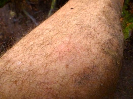 wasp sting
